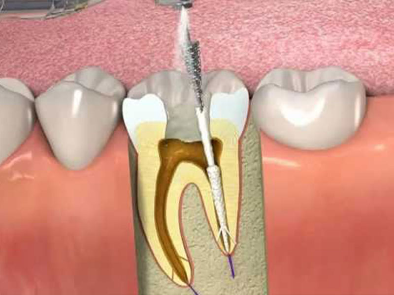 Tedavi ve Endodonti